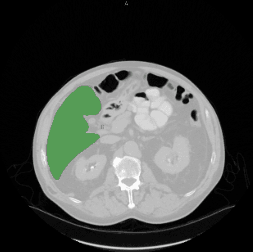 Coupe axiale de scanner abdominal avec le foie repéré en vert